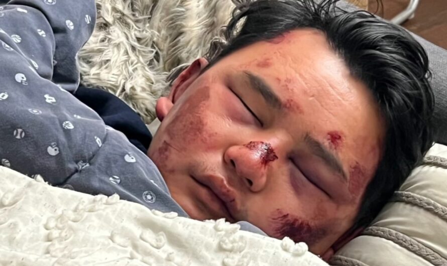 亚裔男子在奥克兰街上买热狗，被偷袭打成“猪头柄”