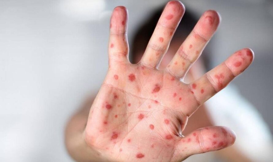 俄勒冈州发现6例猴痘病例，全是男同性恋者