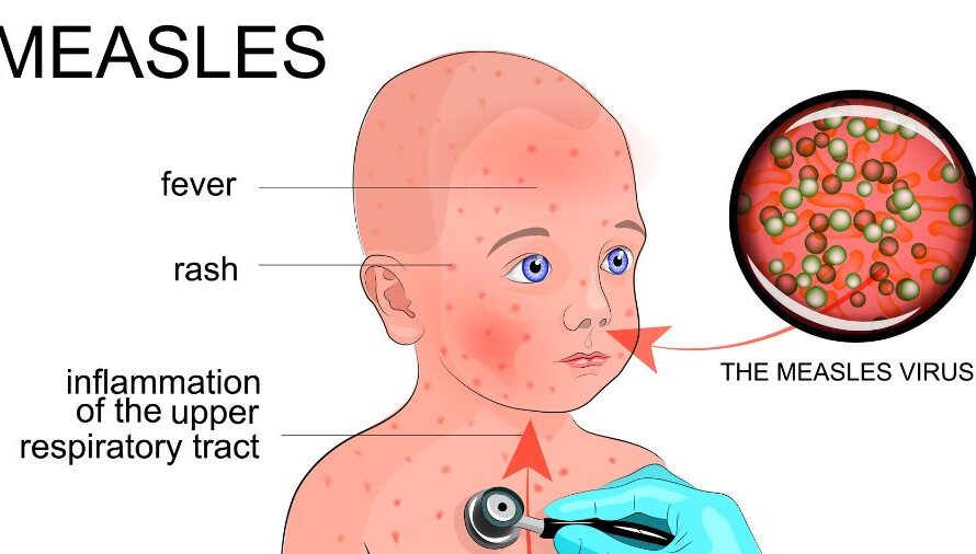 俄勒冈州麻疹疫情自 6 月以来已至少报告 24 例